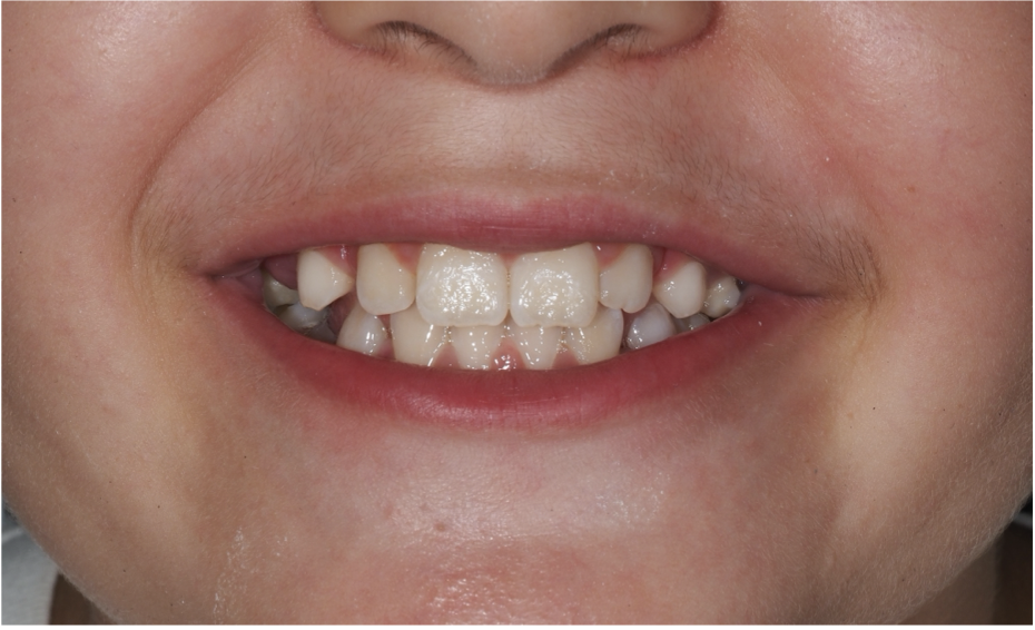 Sourire après traitement, cas 1