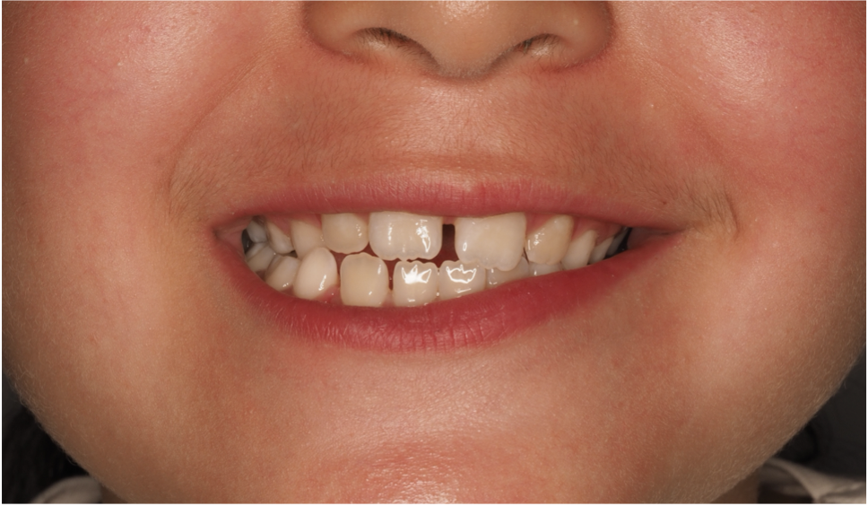 Sourire avant traitement, cas 1