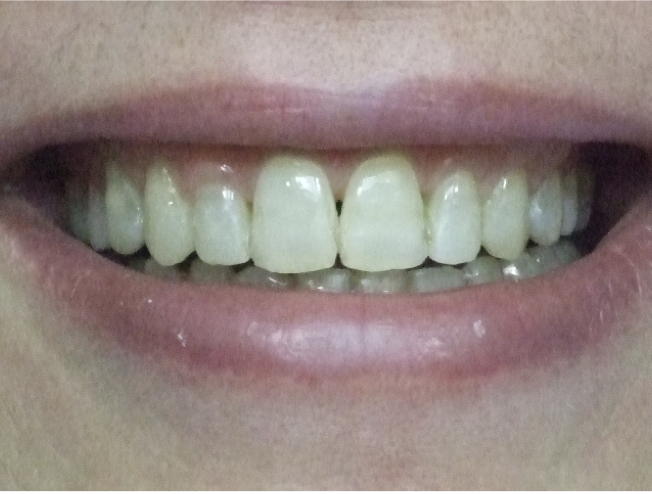 Sourire après traitement, cas 2