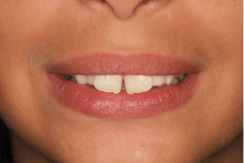 Sourire avant traitement, cas 4